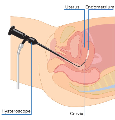 Hysteroscopy - How is it done