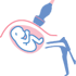 Prenatal diagnosis - Chorionic villus sampling