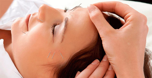 Improve your well-being with acupuncture