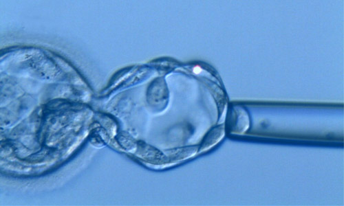 PGD - Embryo biopsy performed at the blastocyst stage